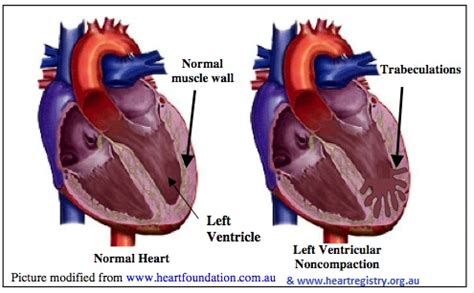 lv non compaction